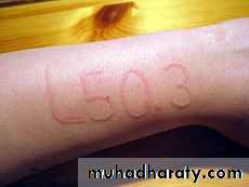 Allergic Diseases