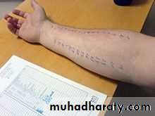 Allergic Diseases