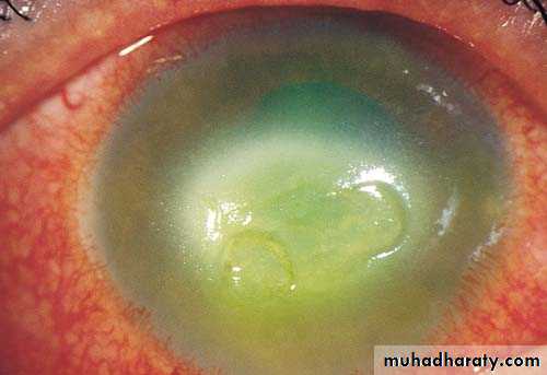 cornea