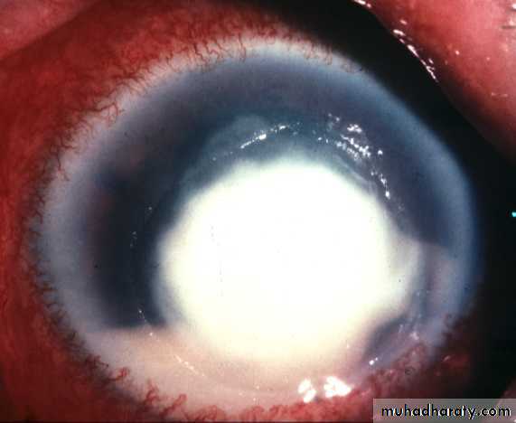 cornea