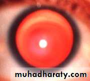 keratoconus