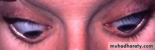 keratoconus