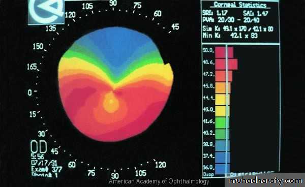 keratoconus