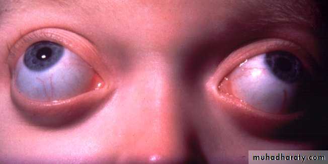 keratoconus