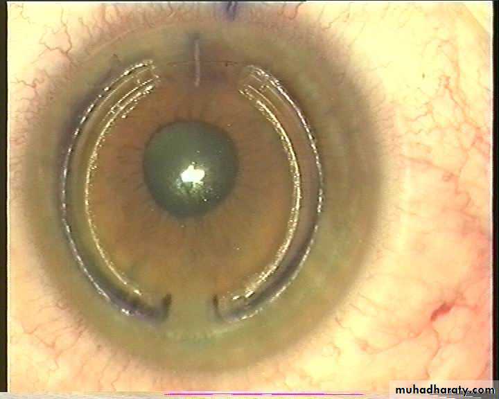 keratoconus