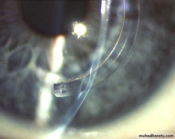 keratoconus