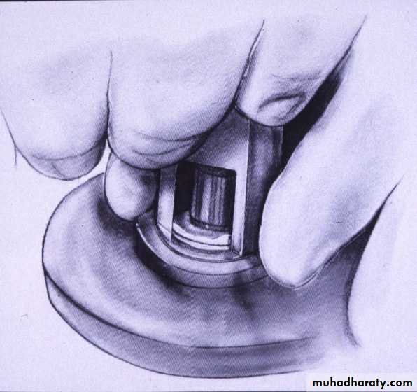 keratoconus