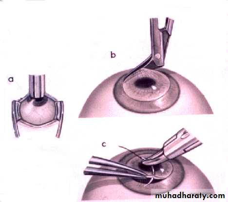 keratoconus
