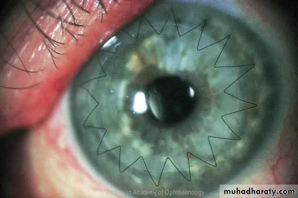 keratoconus