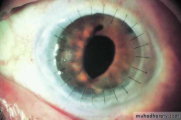 keratoconus