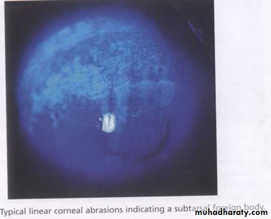 keratoconus