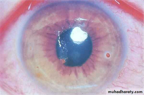 keratoconus