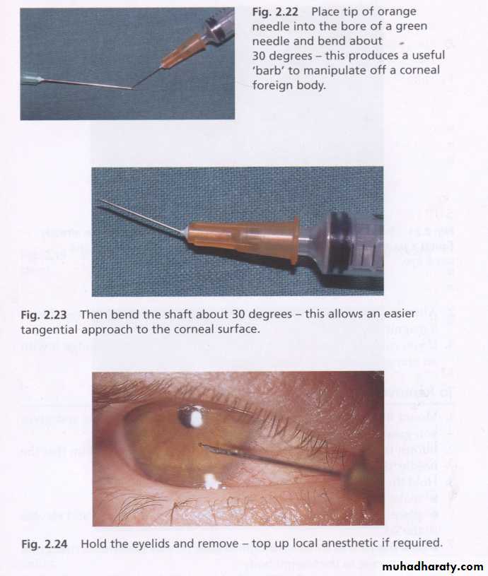 keratoconus