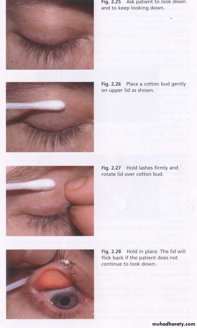 keratoconus