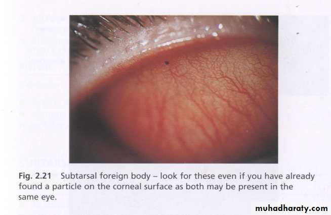 keratoconus