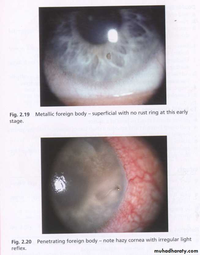 keratoconus