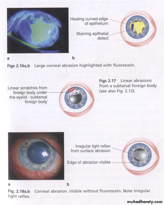 keratoconus