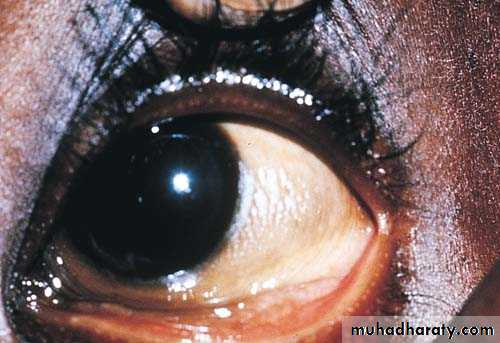 keratoconus