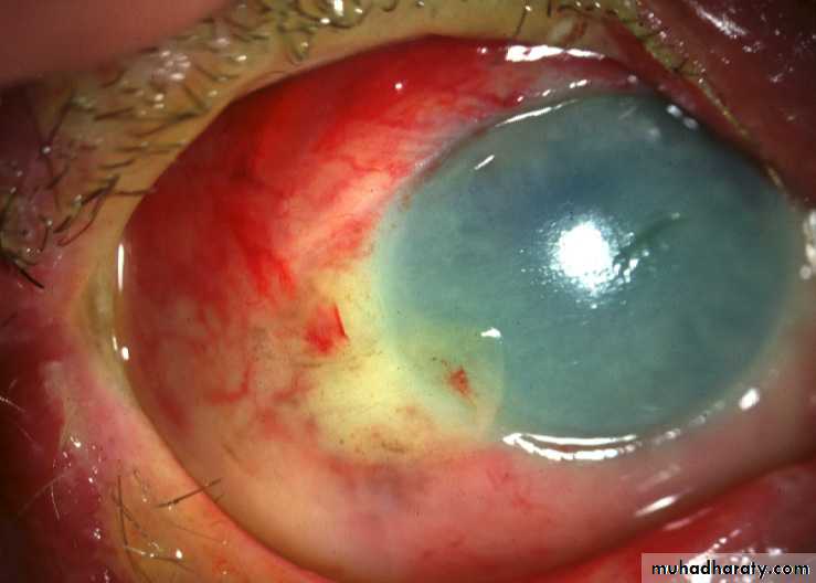 keratoconus