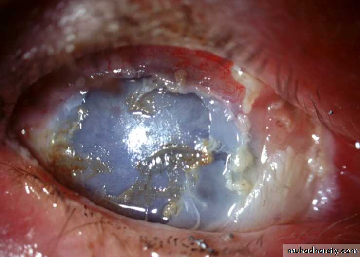keratoconus