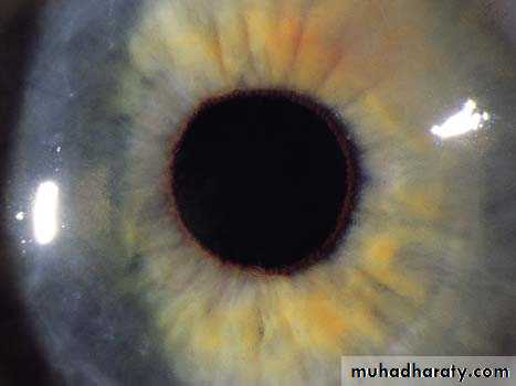 keratoconus