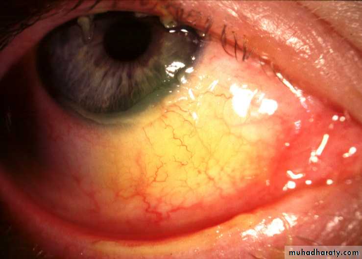 keratoconus