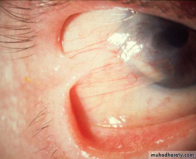 keratoconus