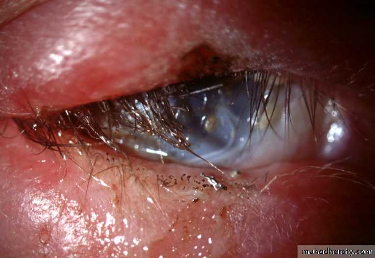 keratoconus