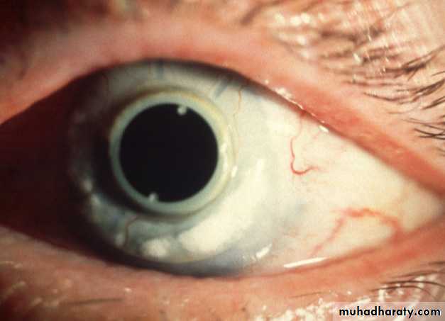keratoconus