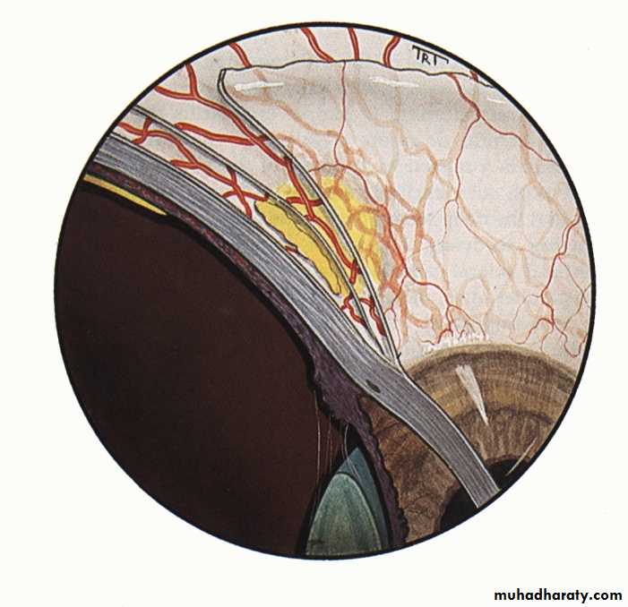keratoconus