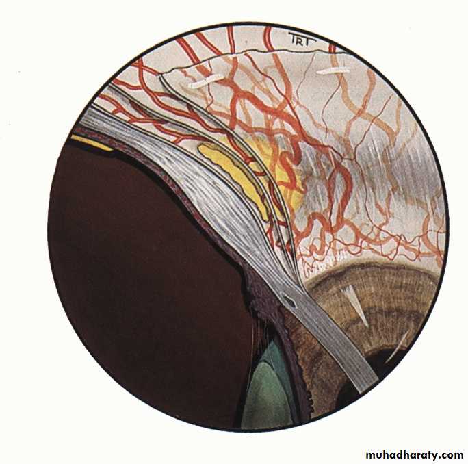 keratoconus