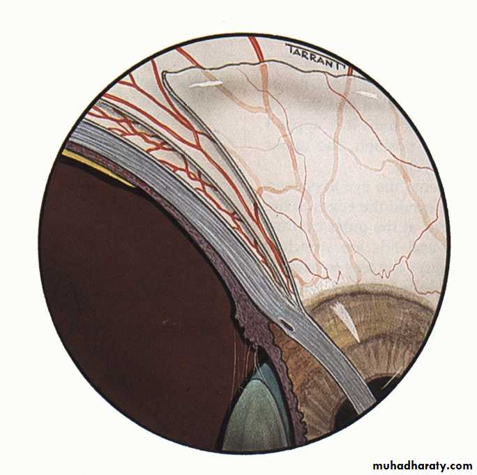 keratoconus