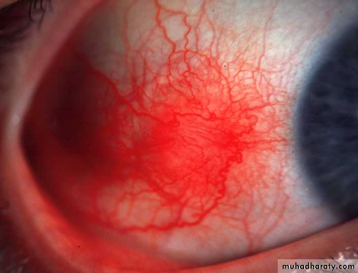 keratoconus