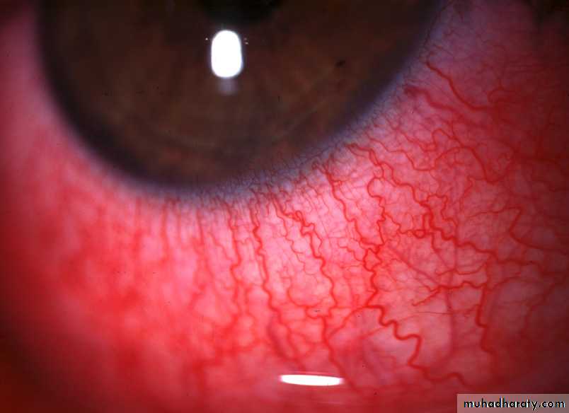 keratoconus