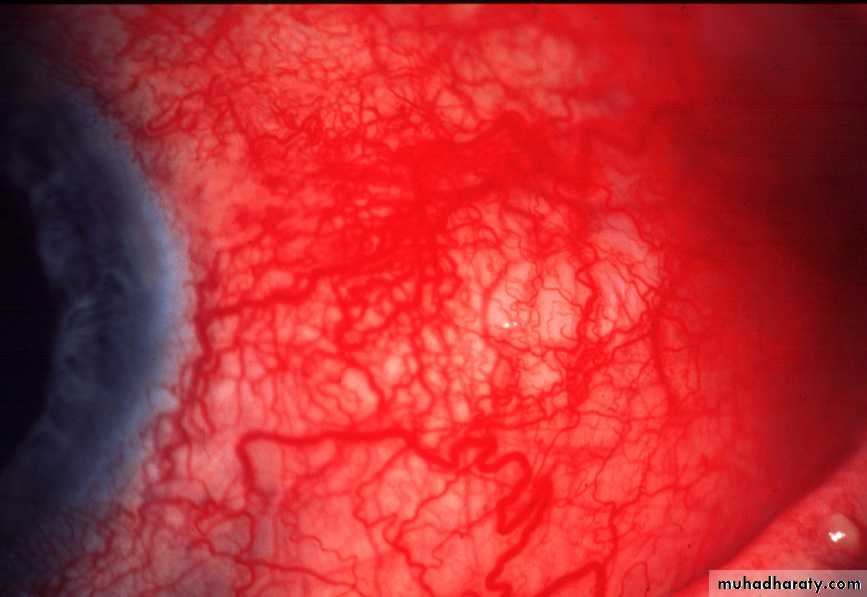 keratoconus