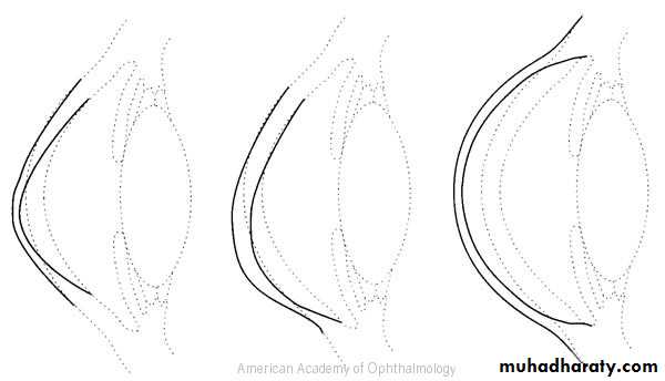 keratoconus