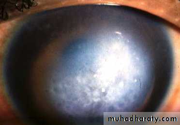 keratoconus
