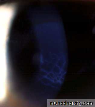keratoconus