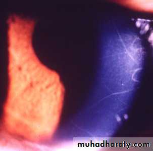 keratoconus