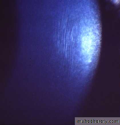 keratoconus