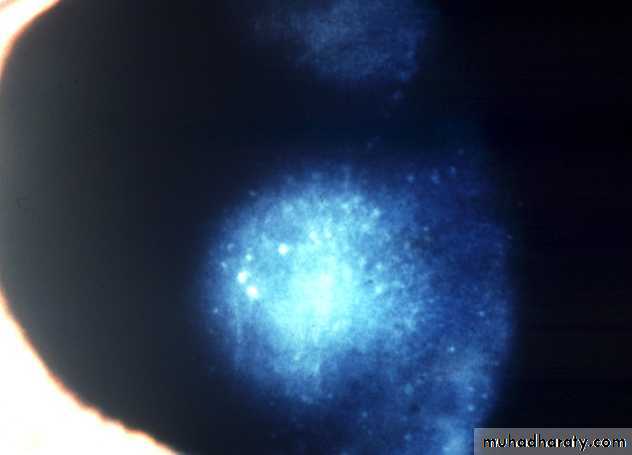 herpes keratitis