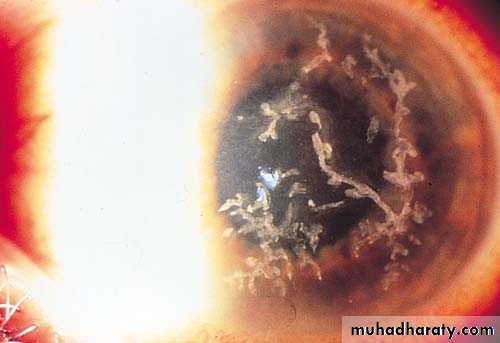 herpes keratitis