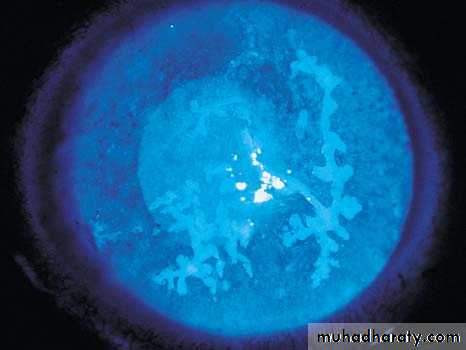 herpes keratitis