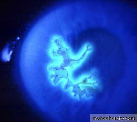 herpes keratitis