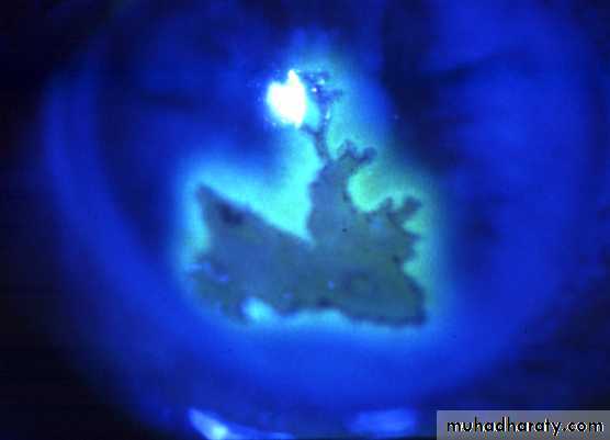 herpes keratitis