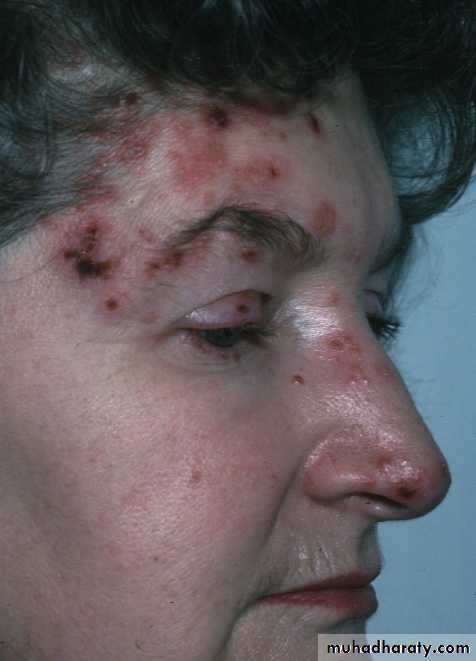 herpes keratitis