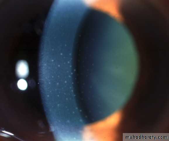 herpes keratitis