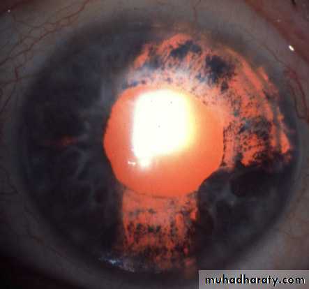 herpes keratitis