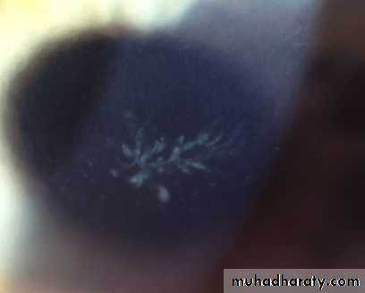 herpes keratitis
