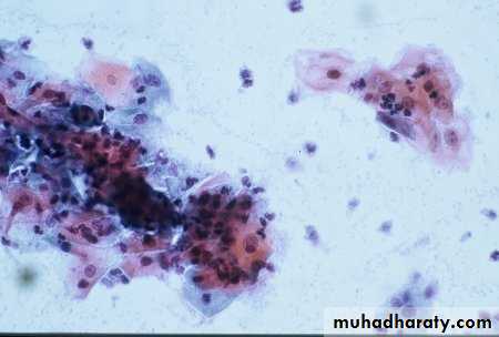 premalignant conditions of cervix